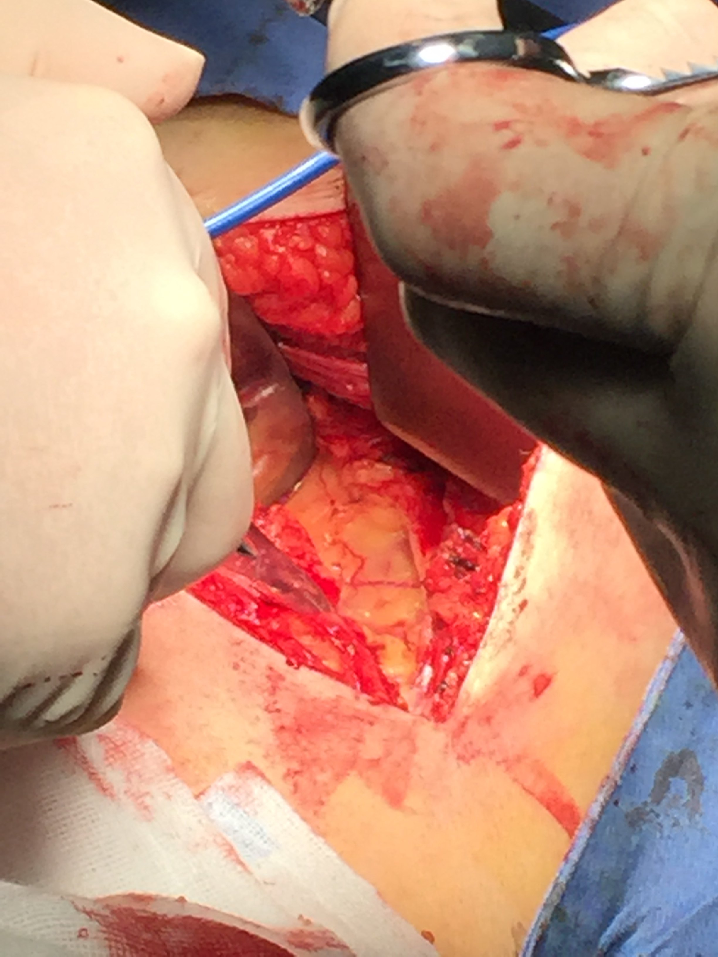 输尿管上段损伤修复3