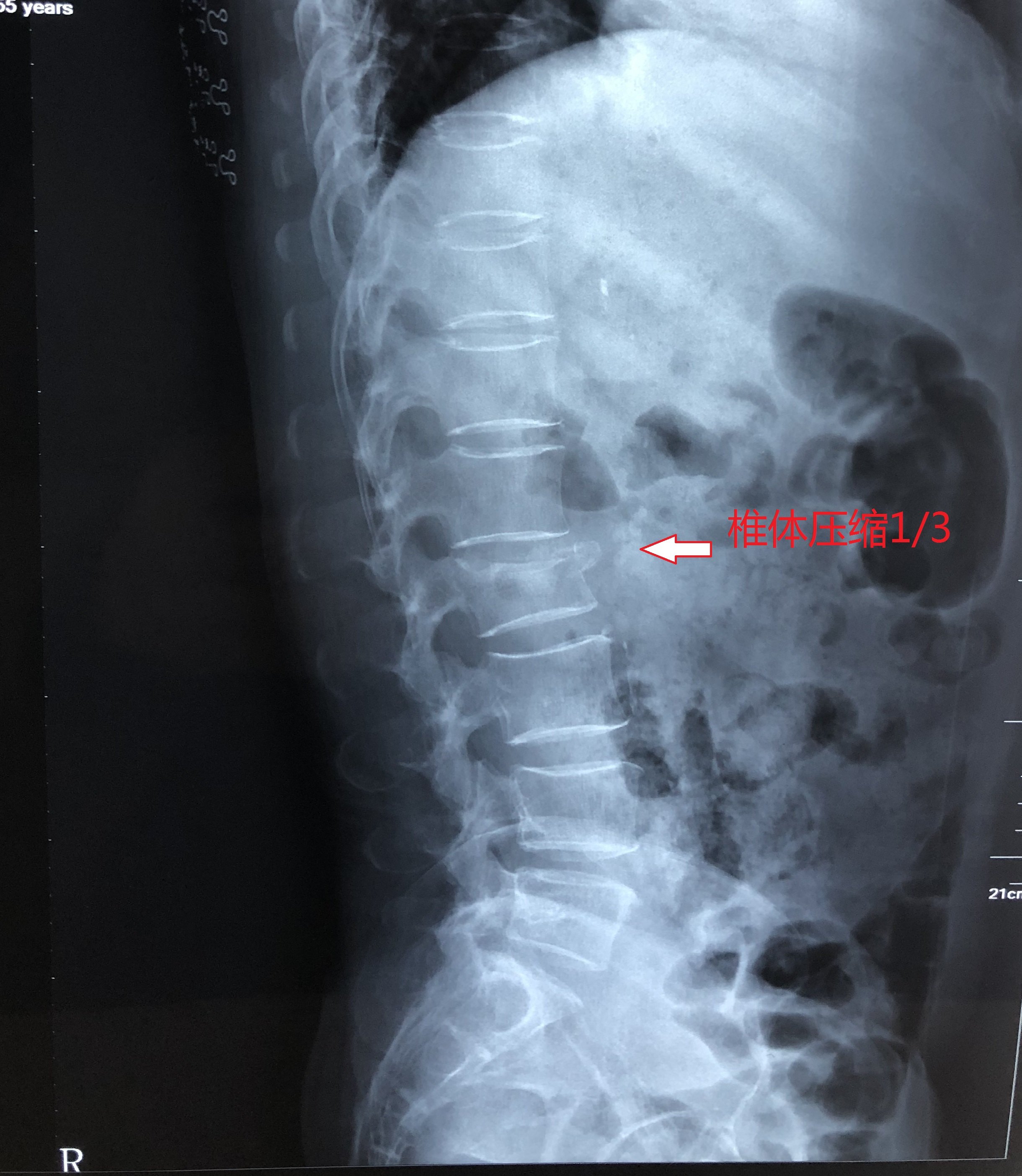 腰椎骨折x光图片