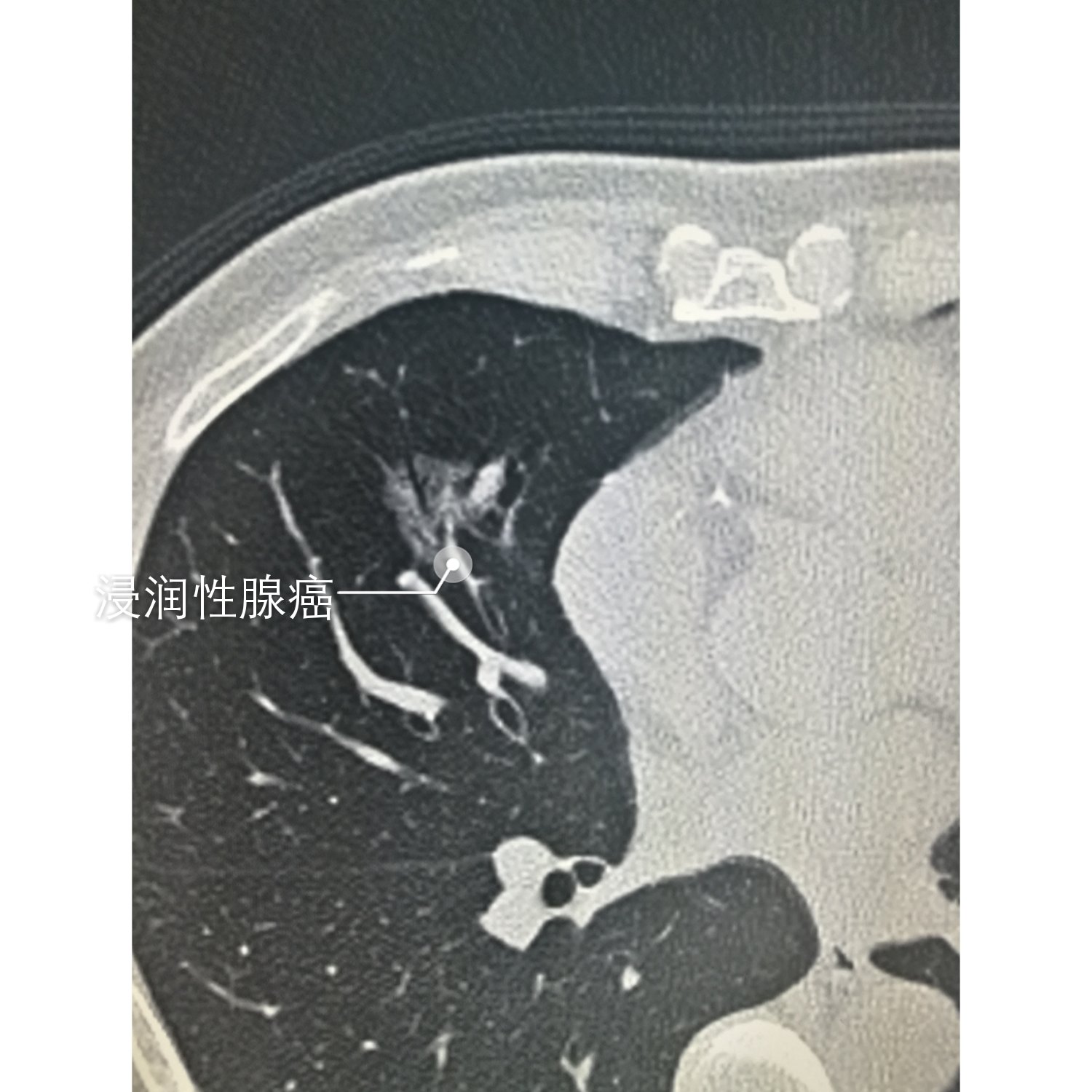 不规则磨玻璃密度结节