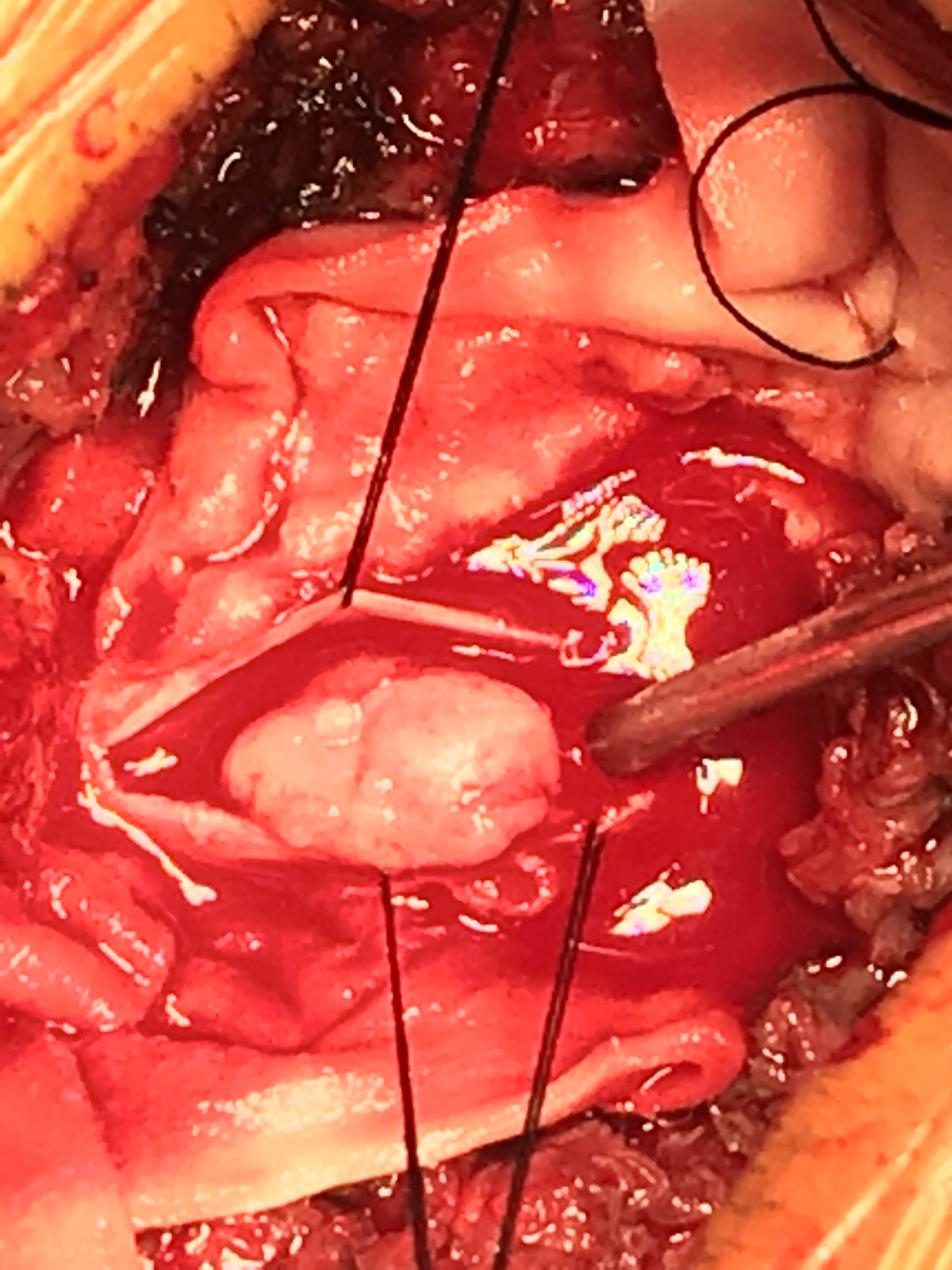 颈椎管内肿瘤手术切除椎板回植技术