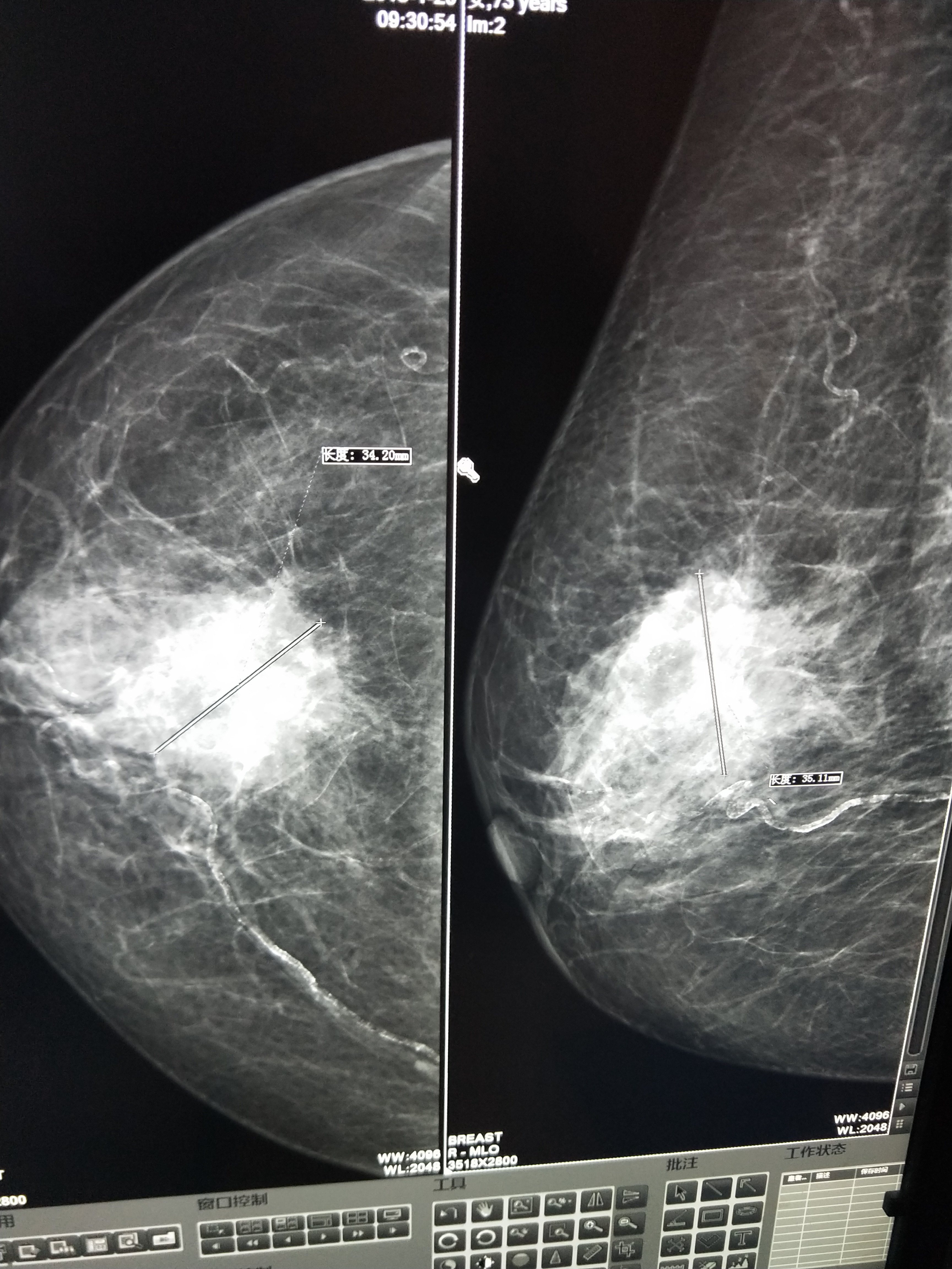 乳腺癌钼靶影像 
