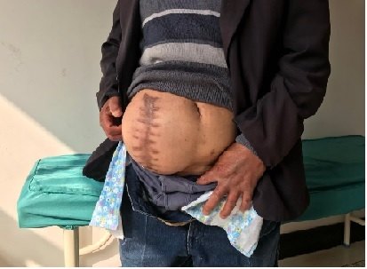 我院疝外科成功为巨大腹壁切口疝实施手术治疗