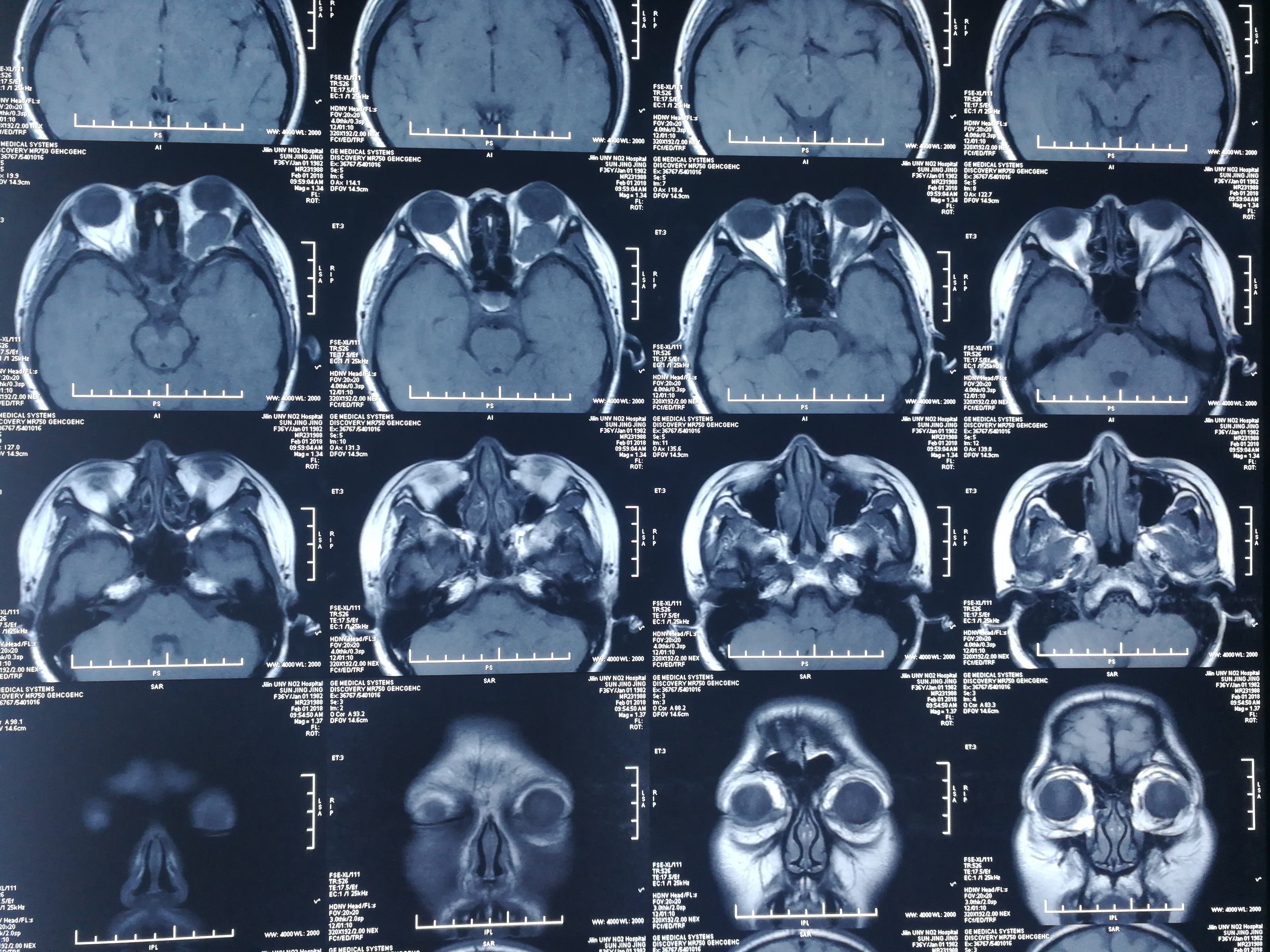 眶内肌锥内巨大海绵状血管瘤 - 好大夫在线