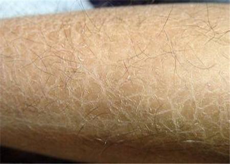 小腿上像鱼鳞一样 是什么病 该怎么治疗 好大夫在线 小腿上像鱼鳞一样 是什么病 该怎么治疗 好大夫在线