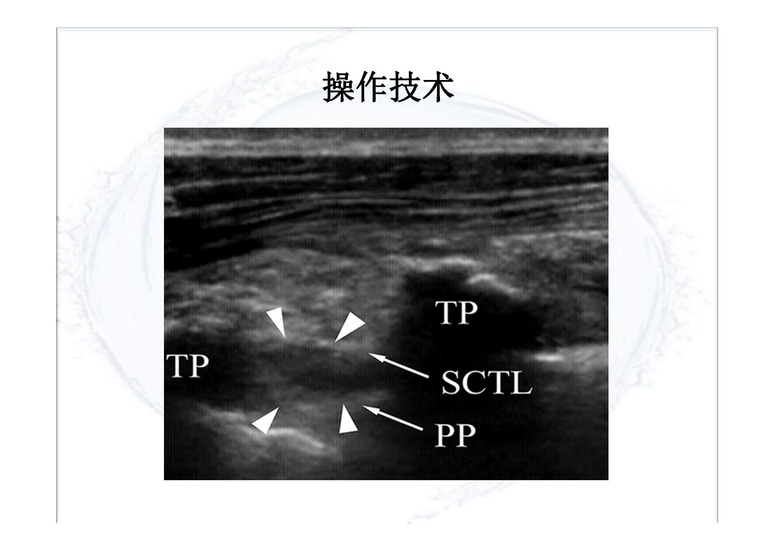 椎旁神经阻滞超声引导图片