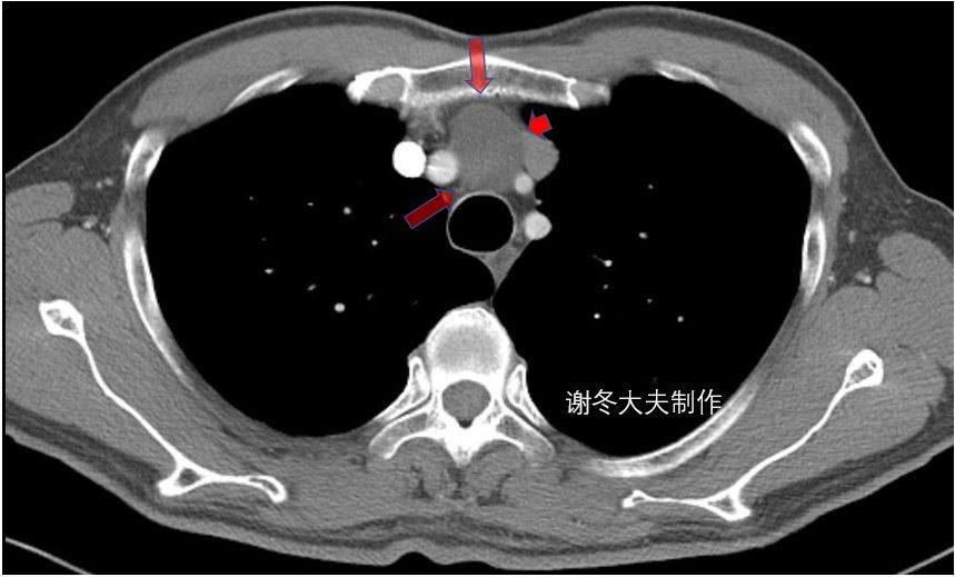 胸腺瘤位置图片图片