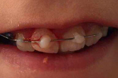 5,对于颌面部软组织伤及牙龈撕裂伤,一般采取局部清创缝合的方法,应