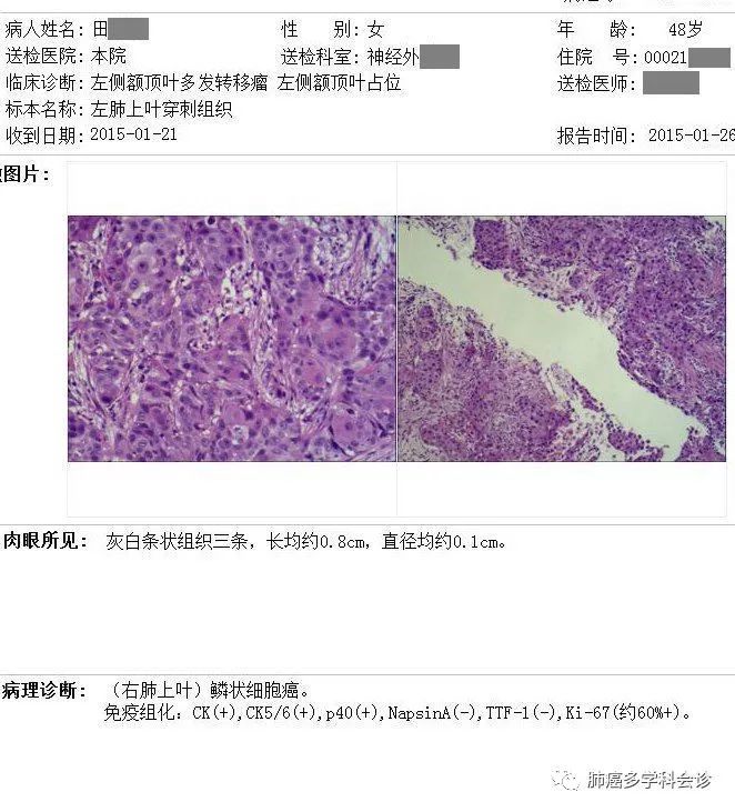 met突變的女性肺鱗癌腦和雙腎轉移