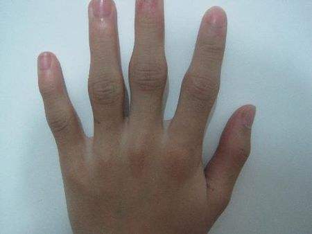 手指多关节肿痛一定是类风湿关节炎吗