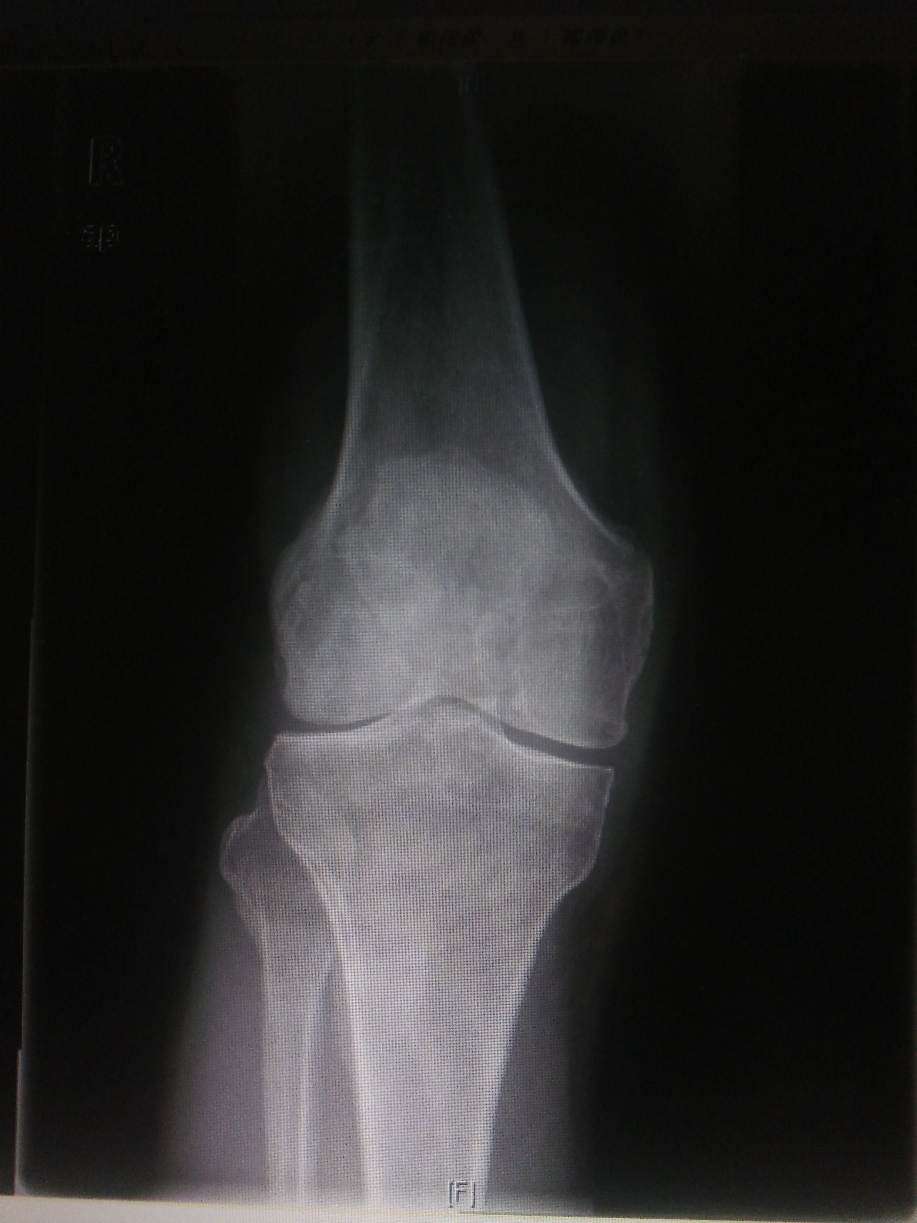 滑膜炎胶囊多久一个疗程_滑膜炎胶囊的适应症_滑膜炎布洛芬缓释胶囊一天吃几次