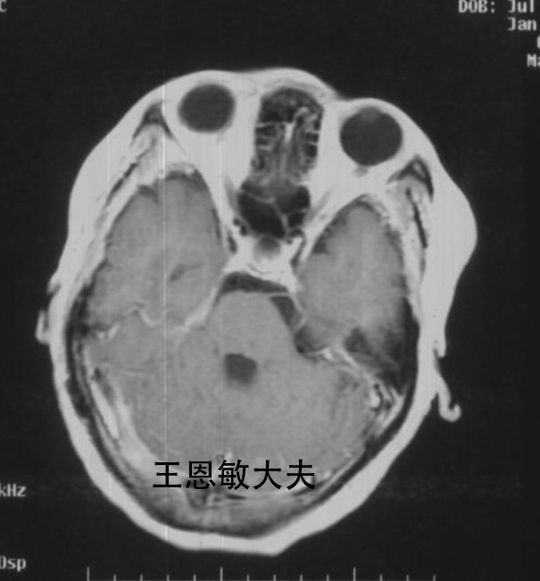 复发听神经瘤的射波刀治疗--每周一例