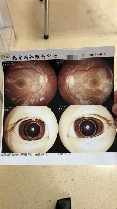 marchesani综合征