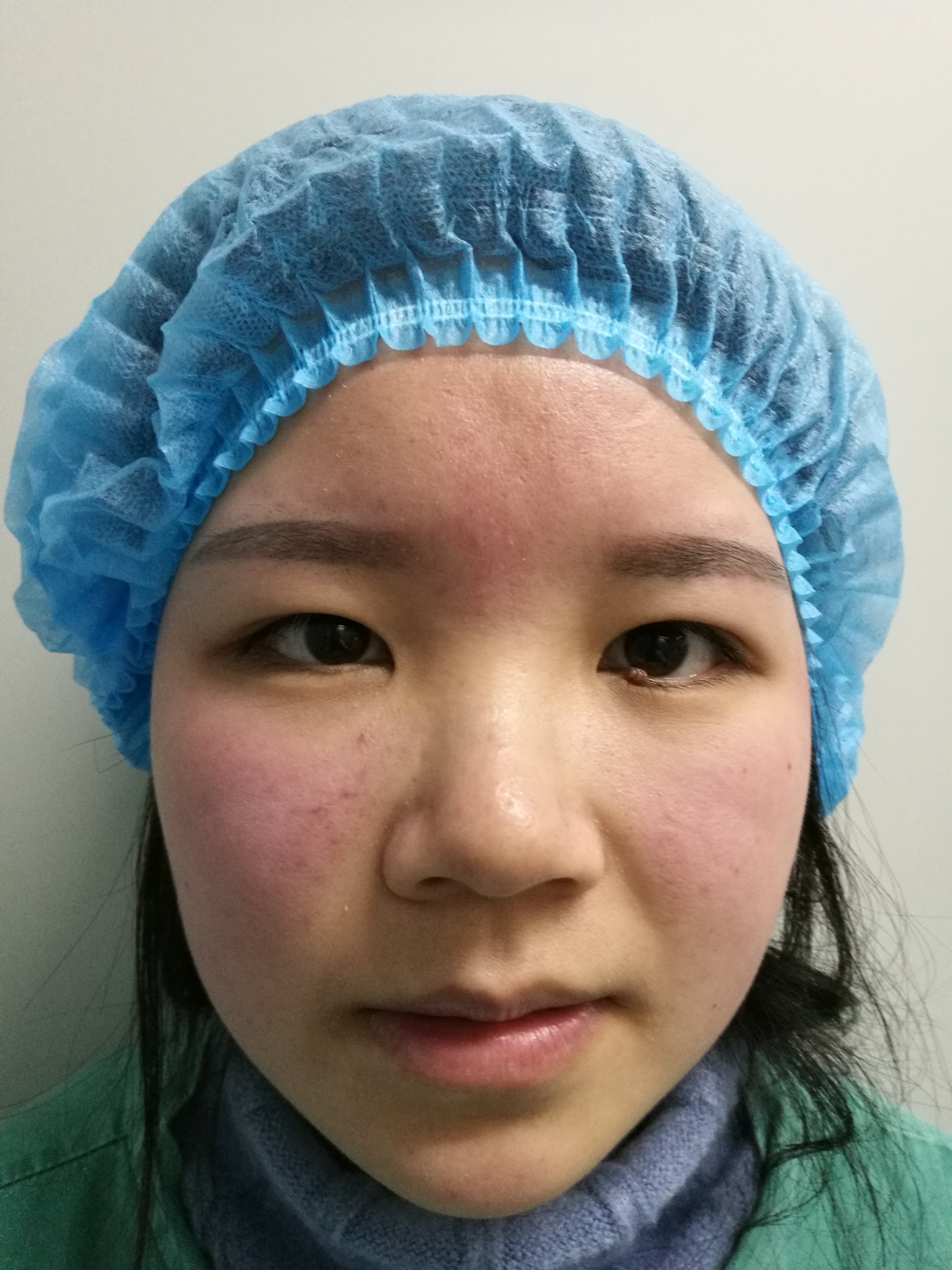 术后即刻术后一周,拆线前拆线后即刻手术心得体会1,睑缘痣一般都是