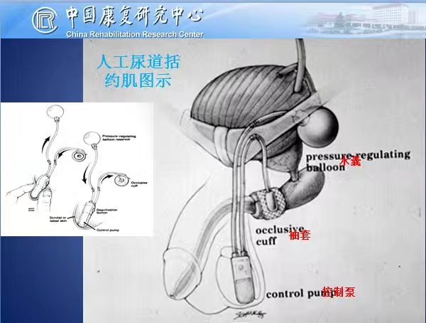 主要治疗方式包括:盆底肌训练,膀胱颈重建,男性吊带及人工尿道括约肌