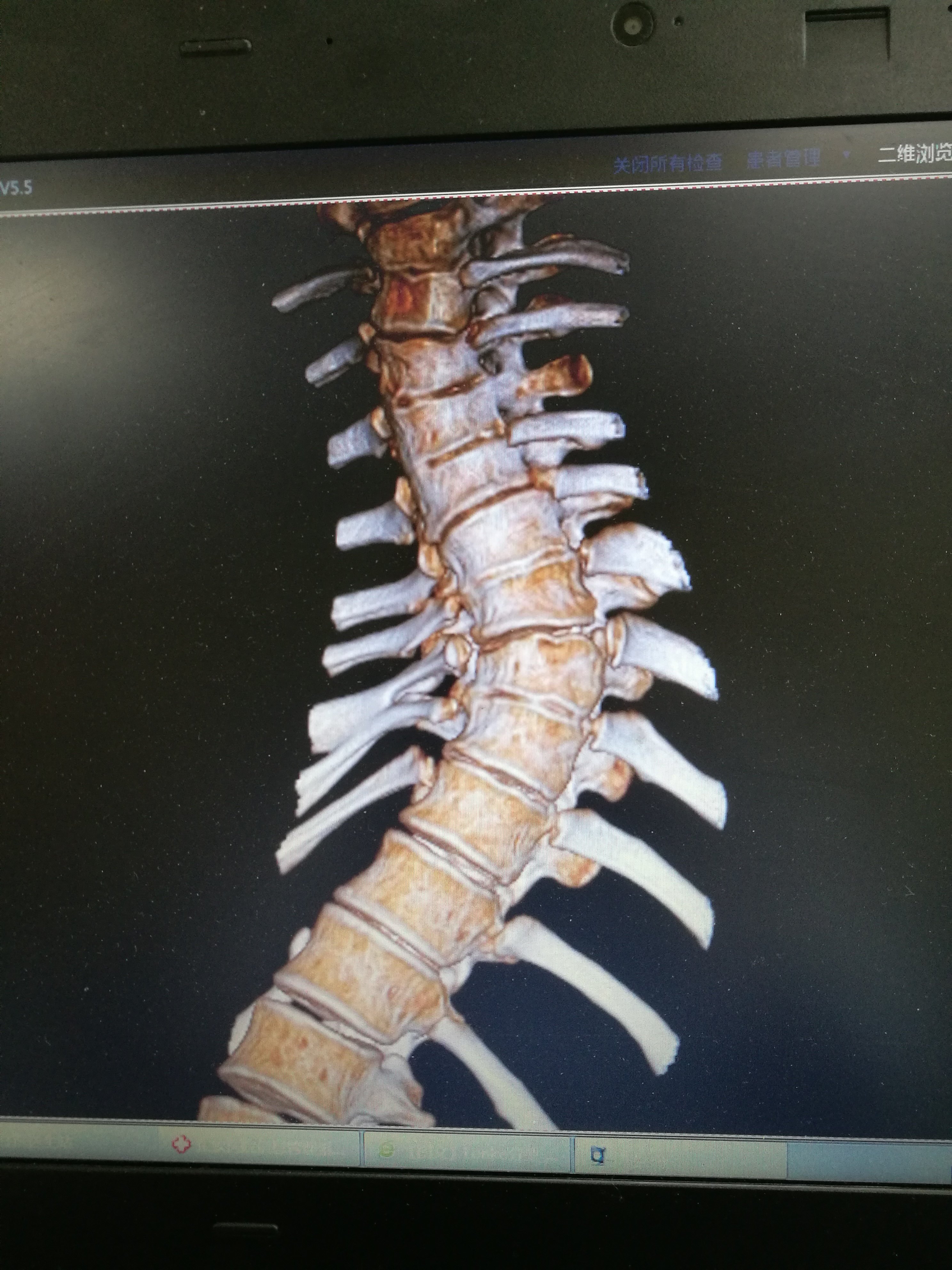 先天性脊柱侧弯矫形术,女,14岁 