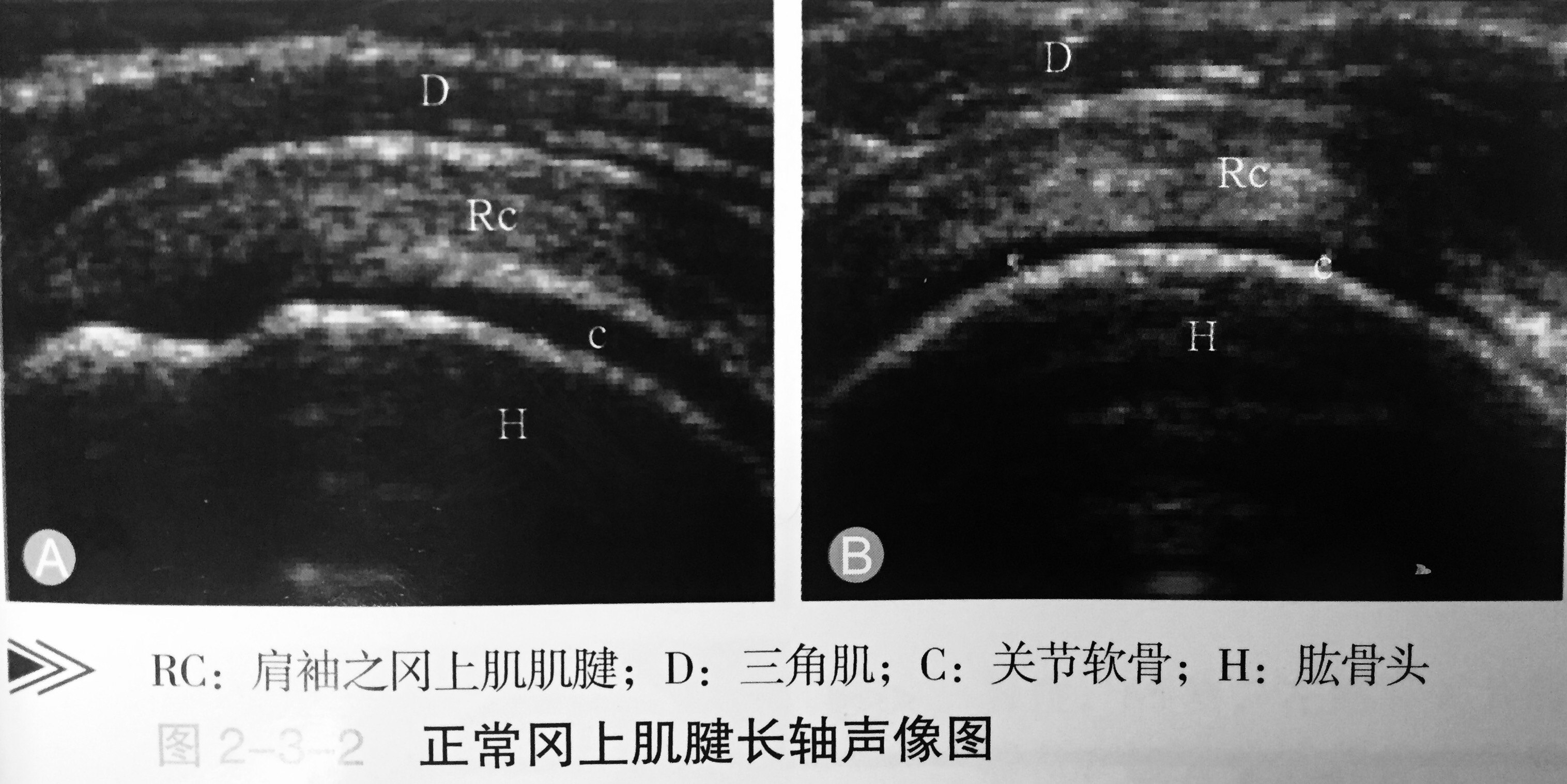 超声评估肩部异常需要精准的技术方法,当上肢置于肩袖肌腱达到最大