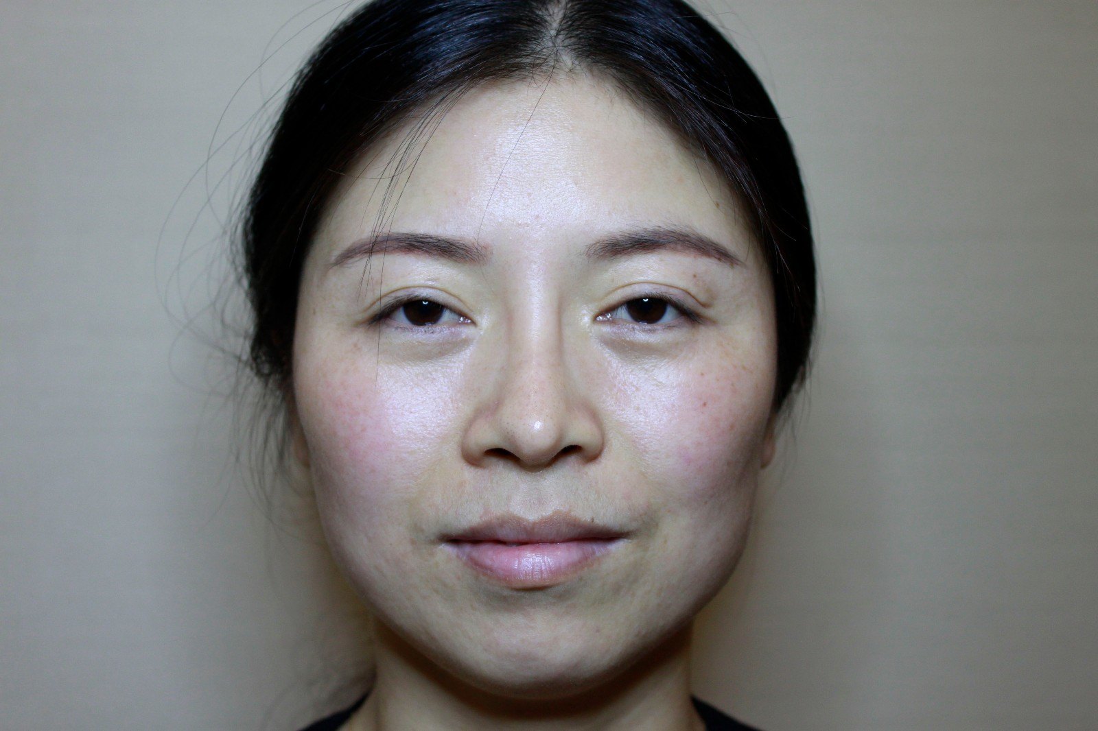 鼻部假体置换隆下颌面部微创提升,酒窝成形的