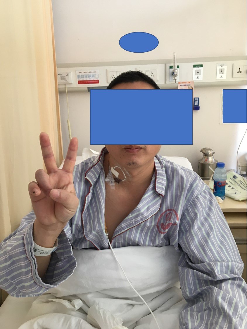 内镜下经鼻入路切除垂体囊肿一例