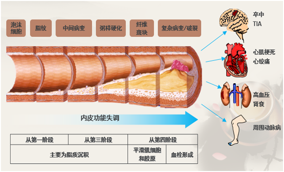 瘀血停留,脂類物質掛在血管壁上,隨著血流在衝擊時刻會有脂質斑塊脫落