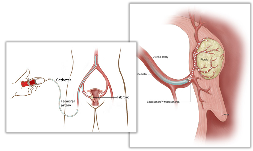 是采用精确选择到患者的子宫动脉注射微小的栓塞物质达到子宫肌瘤和腺