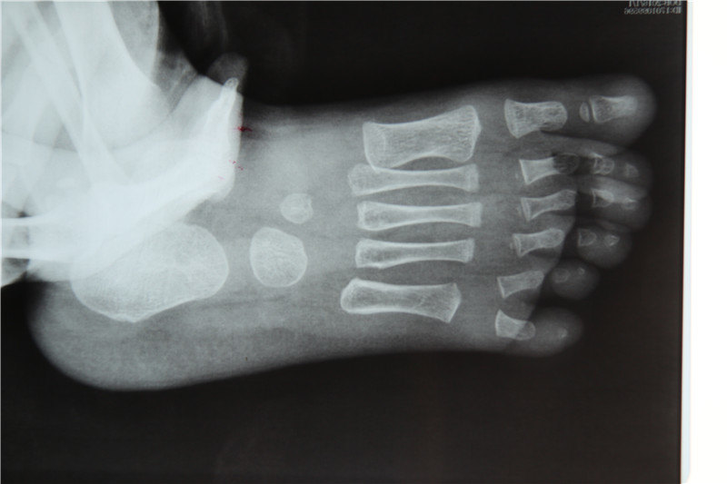 六趾畸形六个脚趾头迷信说法六趾畸形是什么原