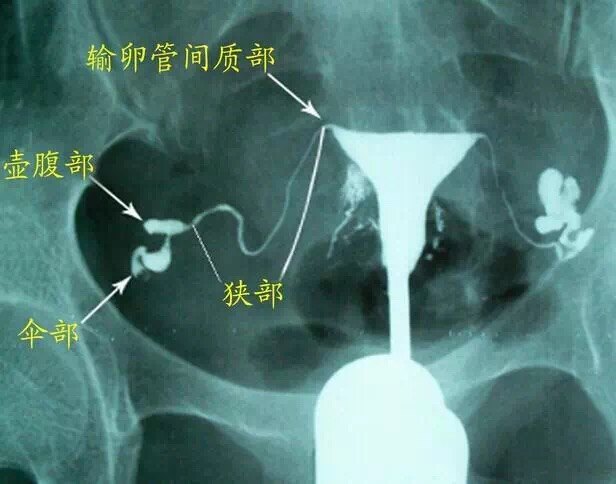 鵲橋是否完好3d超聲下的輸卵管造影幫你探路