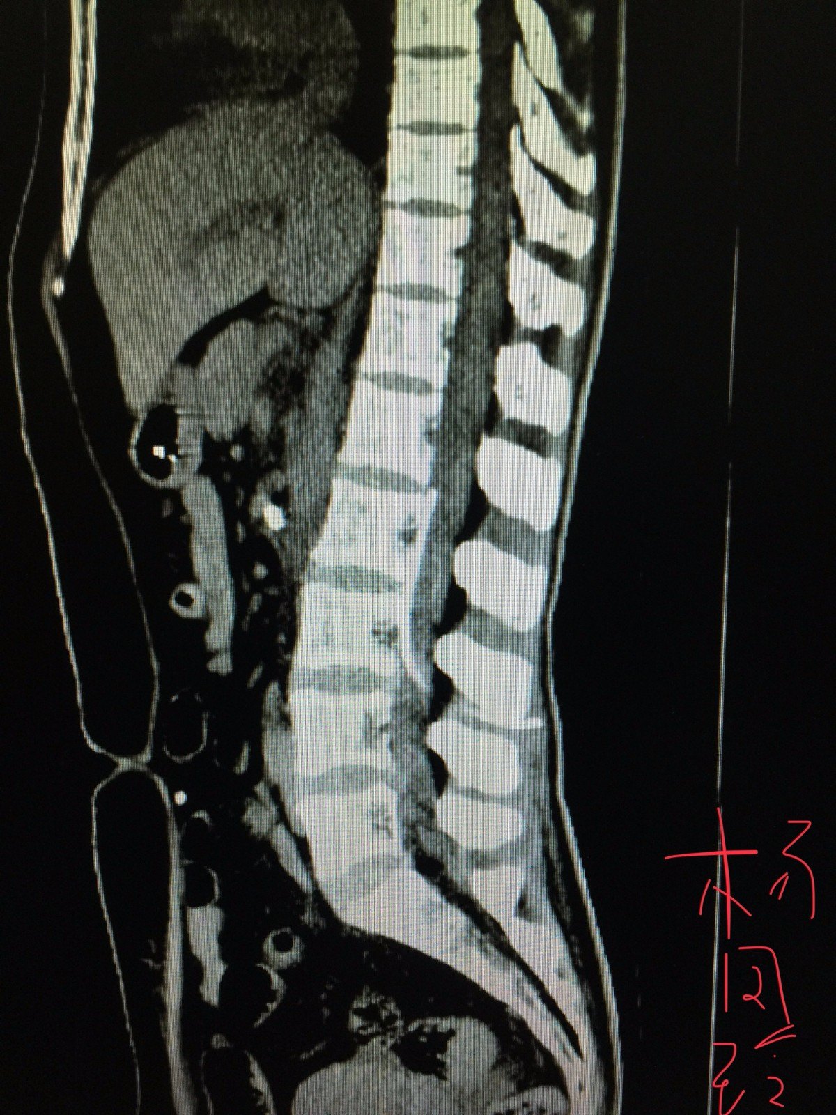 脑积水腰大池-腹腔分流术的适应证及其优点 - 好大夫在线