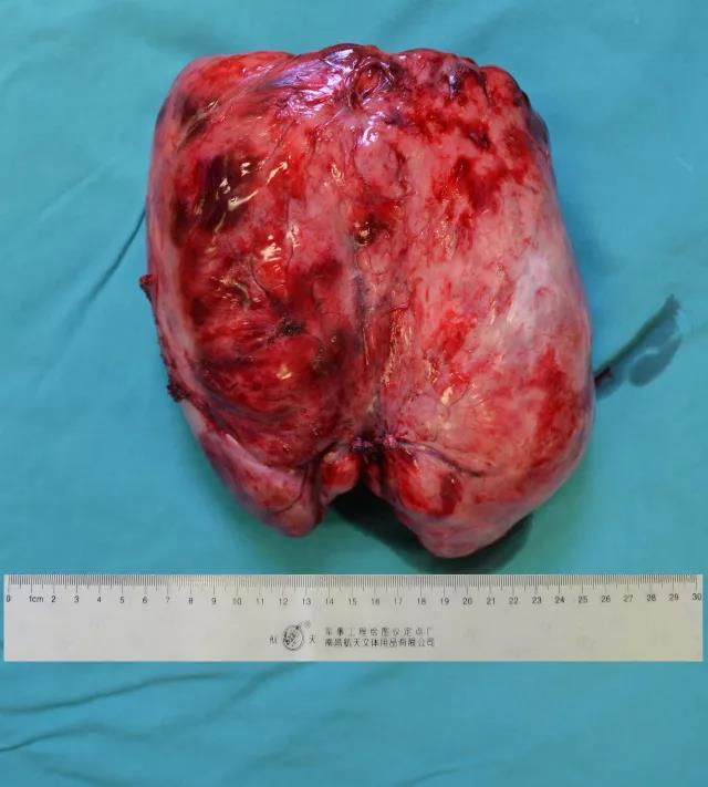 南方医院胸外科成功切除一例胸腔巨大孤立性纤维瘤 - 好大夫在线