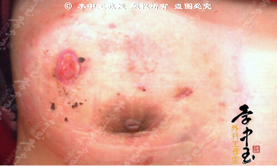 乳腺炎初期红肿图片图片