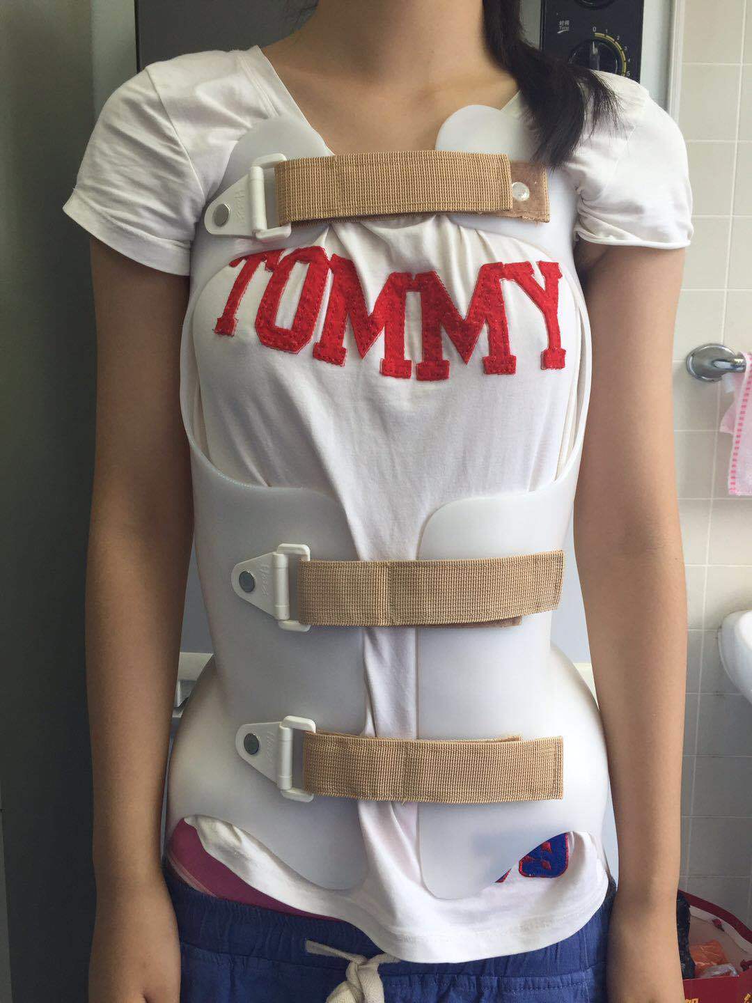 支具有什么效果?_小儿脊柱侧弯 - 好大夫在线