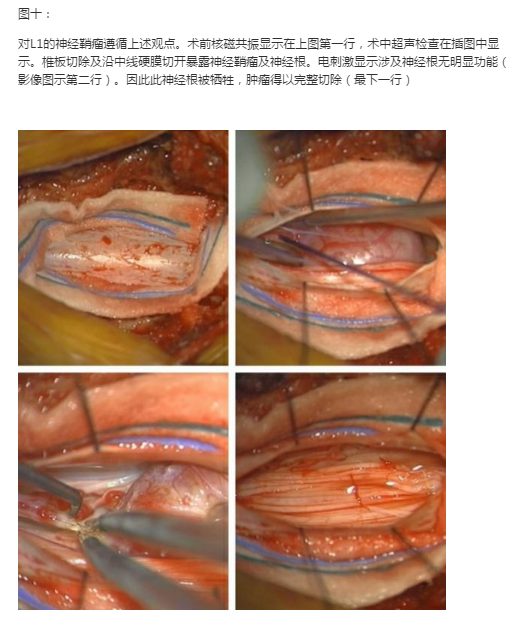 髓外肿瘤的治疗