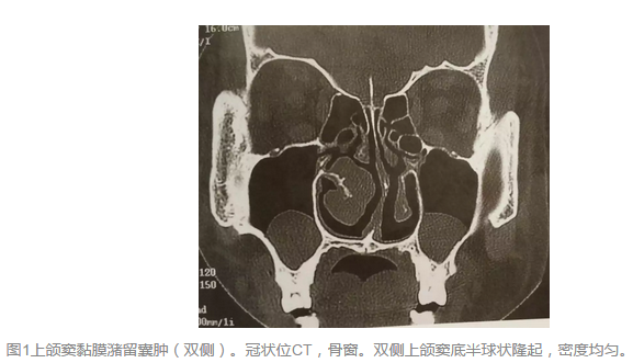 冠狀位ct,軟組織窗,左側蝶竇軟組織密度類圓形病灶.