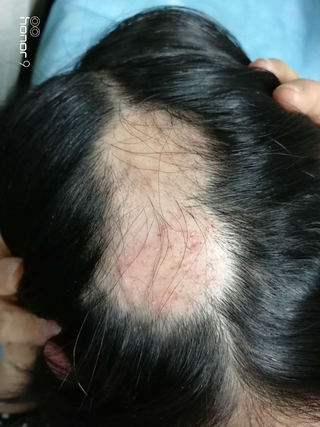 斑秃——火针治疗2个月后效果反馈,有图有真相. - 好大夫在线