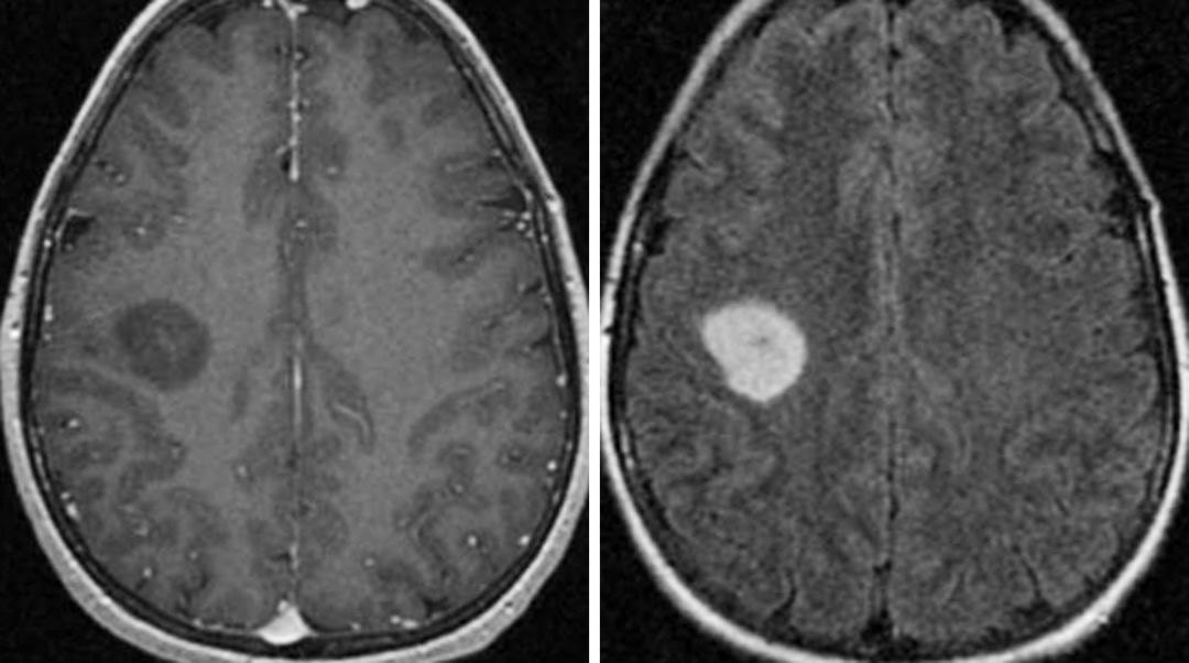 低级别弥漫性星形细胞瘤的病理,临床和影像学特点