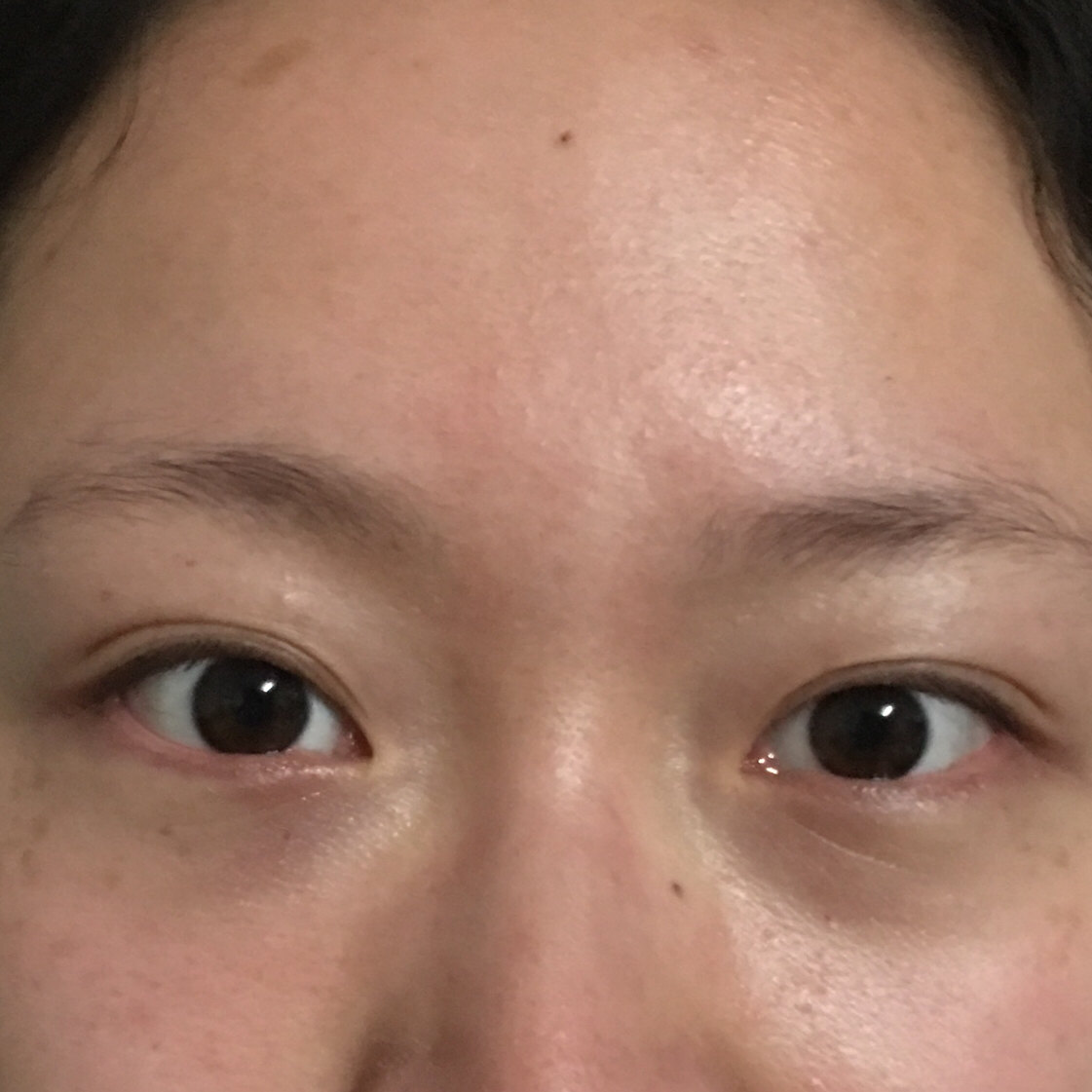 眼袋大,显得没精神怎么办? - 好大夫在线