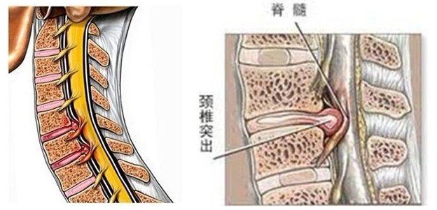 你好,颈椎病系列科普(一):哪些症状说明你得了颈椎病_颈椎病_疾病介绍