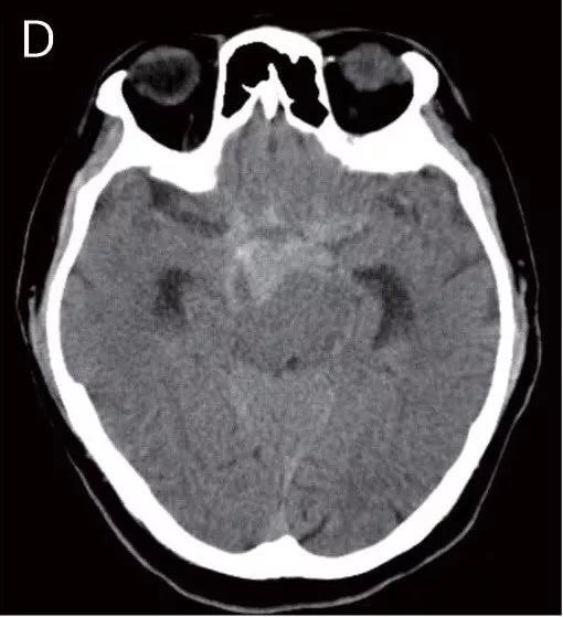 teaching neuroimages: vertebrobasilar dolichoectasia with