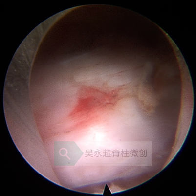 什么是腰椎管狭窄症的最微创手术治疗方法?