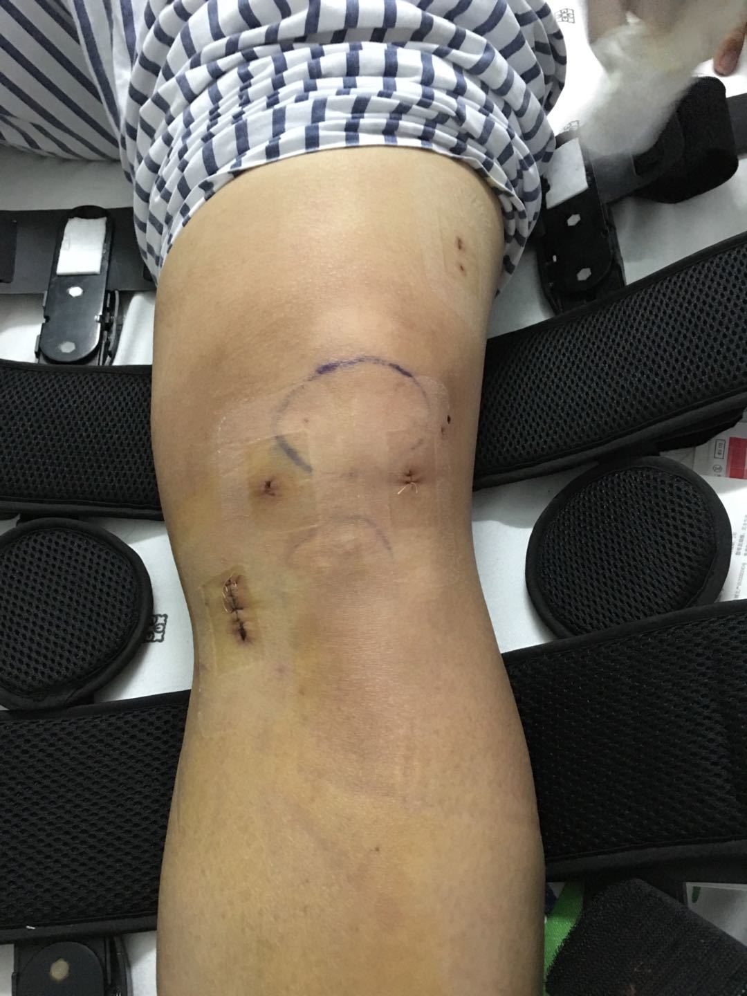 前交叉韧带重建术是不是很可怕? - 好大夫在线