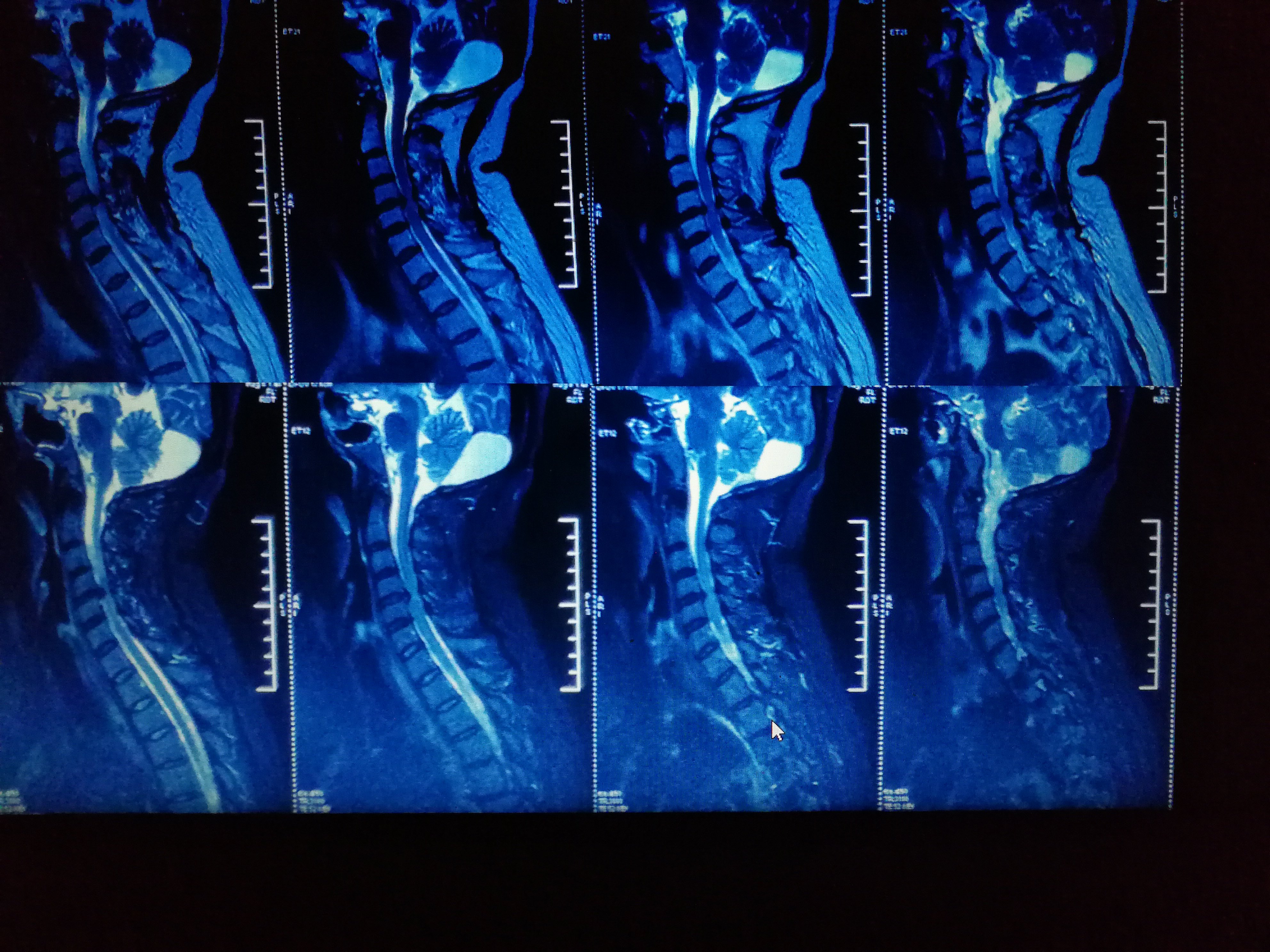 颈椎4,5间隙椎间盘突出脊髓明显受压ct显示椎体骨质增生不明显病人