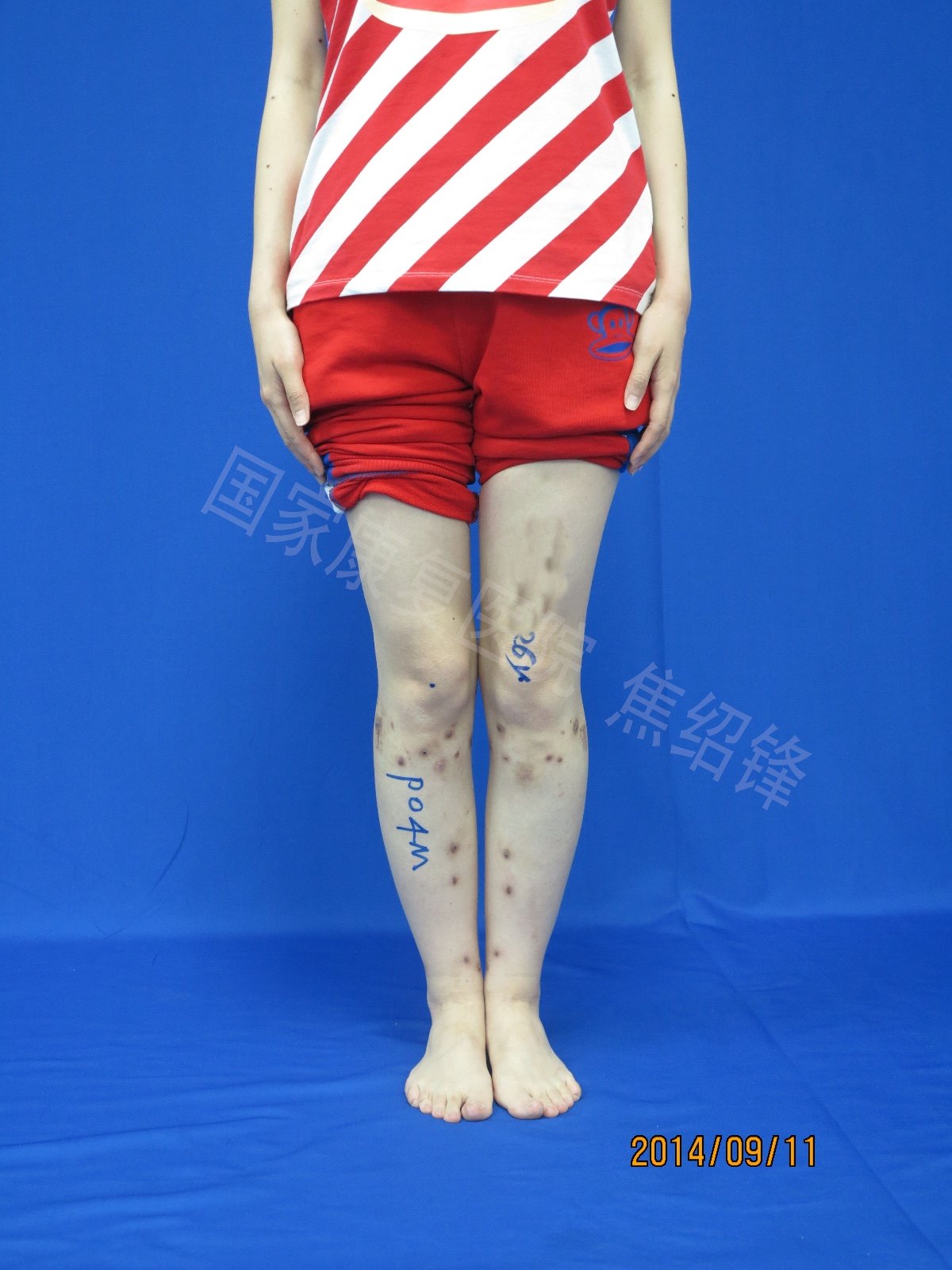 轻度膝内翻有必要手术治疗吗?