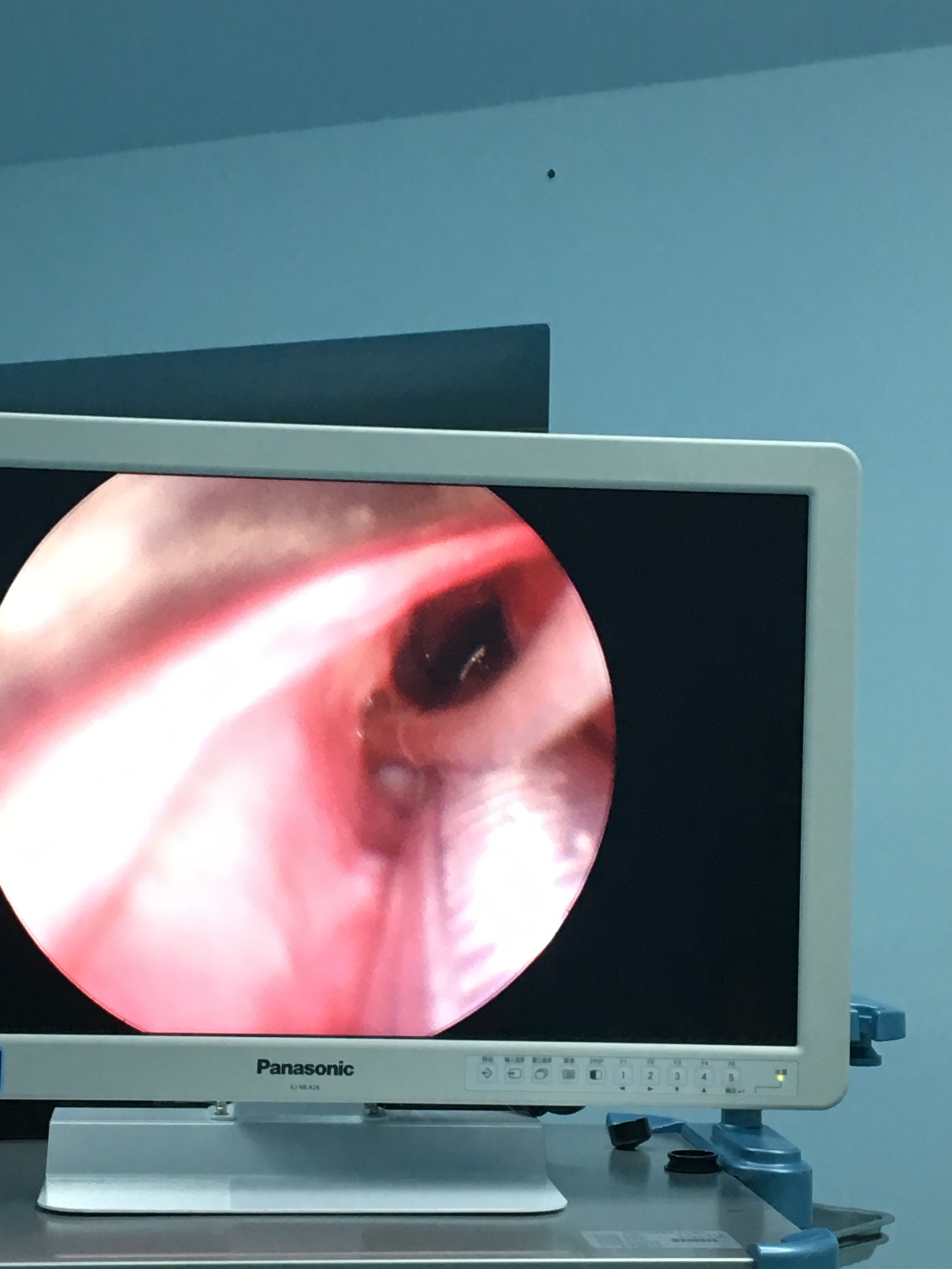 一例全麻下支撑喉镜声带暴露困难的声带息肉手术的分享 