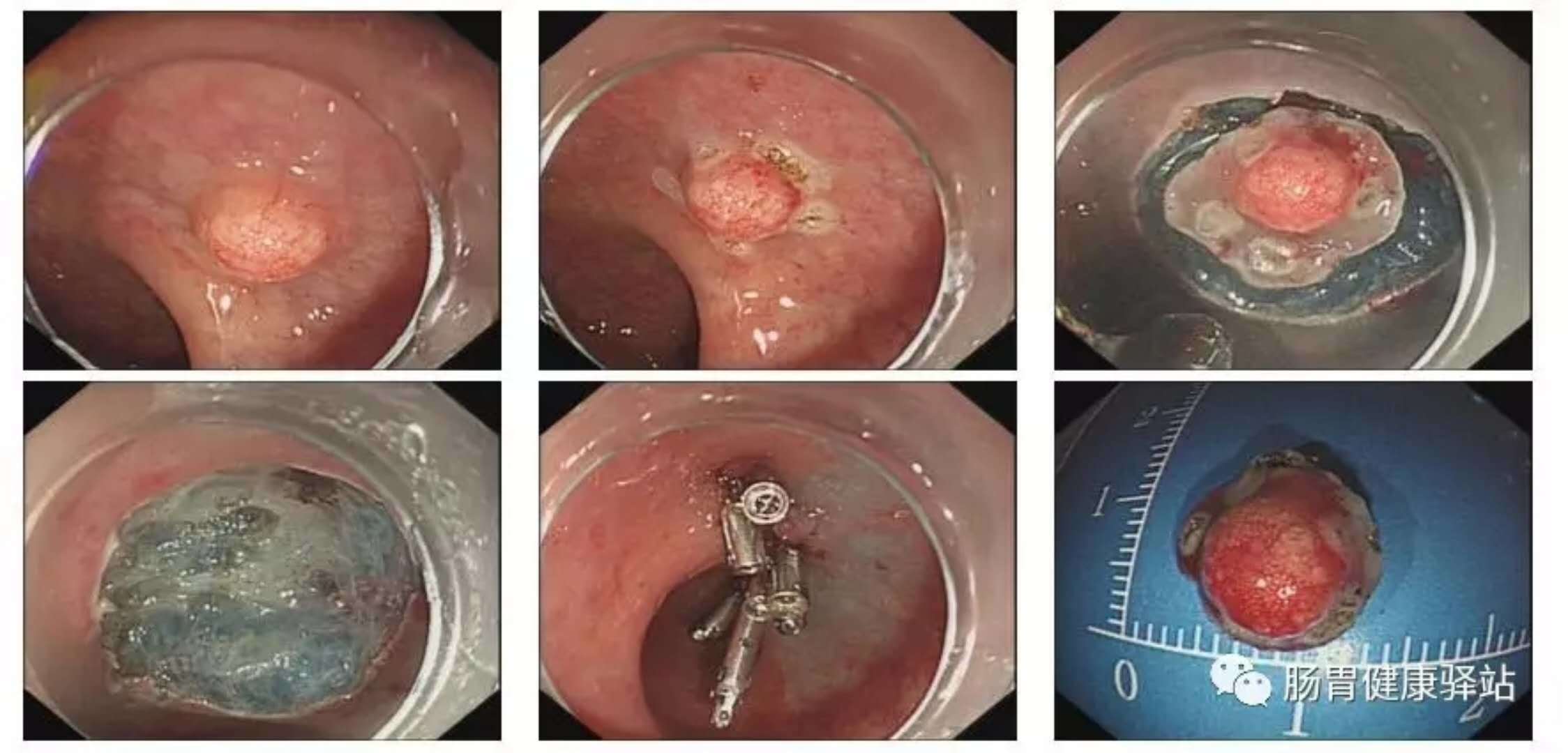 消化道粘膜下肿物内镜切除技术介绍