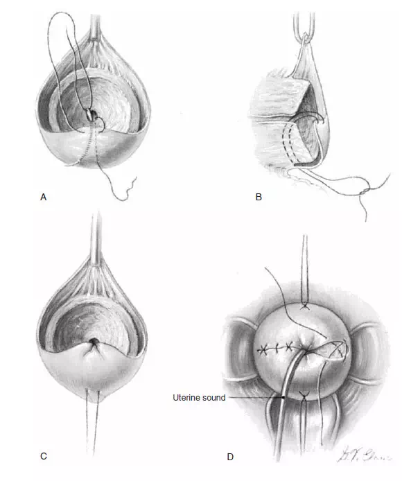 宫颈提拉式缝合法图片图片