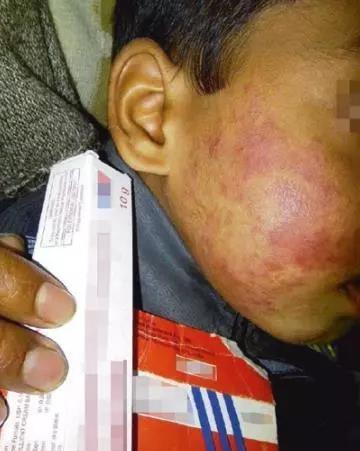 如何为儿童选择激素类药膏?