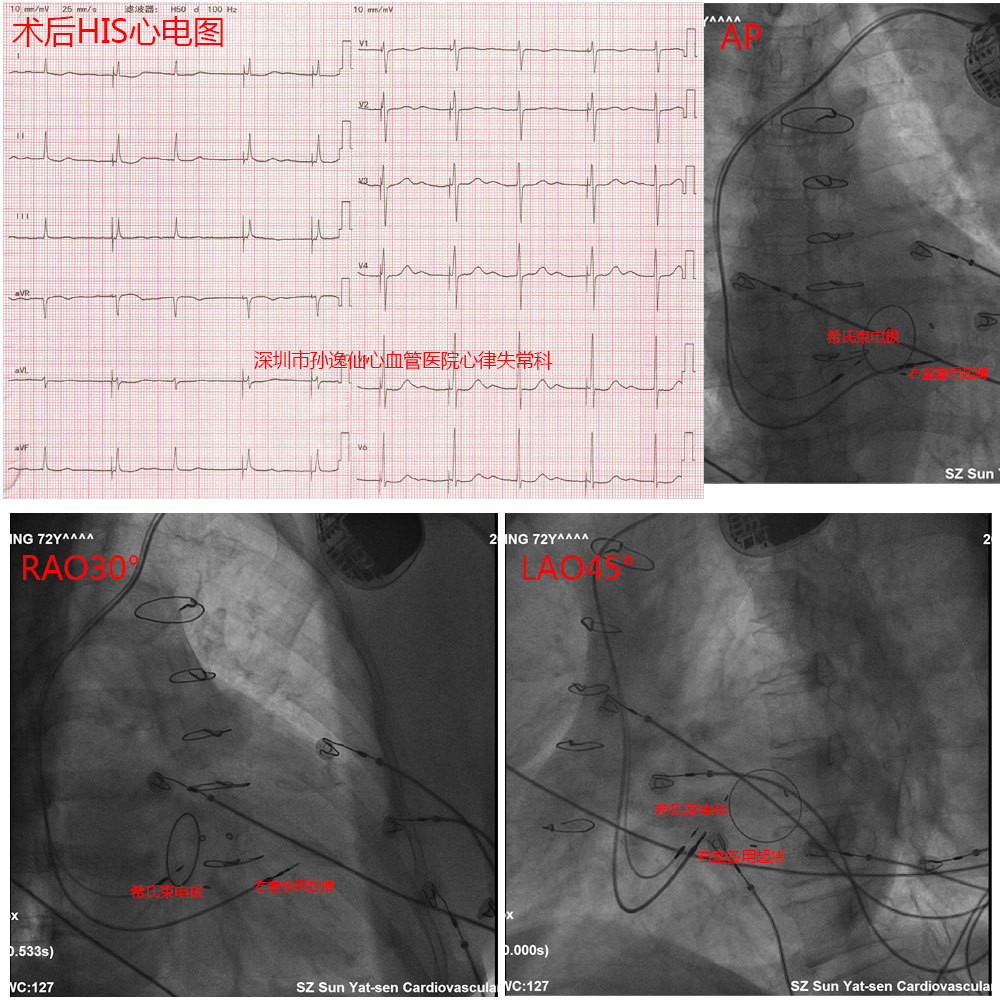 缓慢性心律失常患者的福音——永久性希氏束起搏