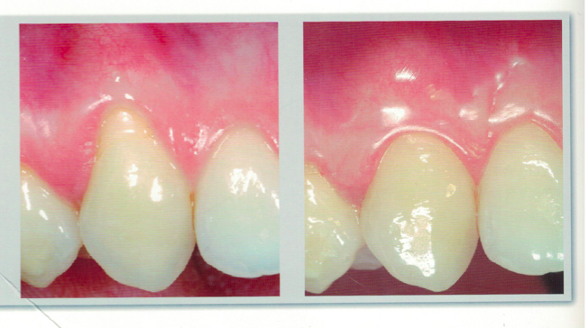 什麼樣的牙齦退縮能夠通過手術治療恢復正常