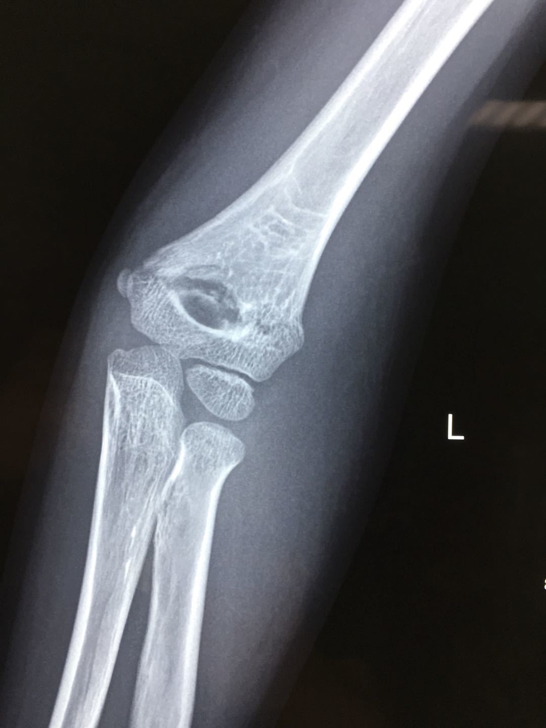 肱骨髁上骨折屈曲型图图片