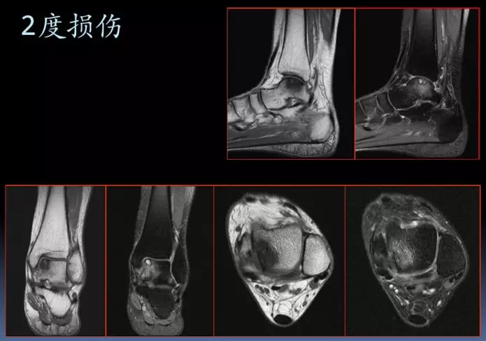 踝关节距骨软骨损伤分级分度 - 好大夫在线