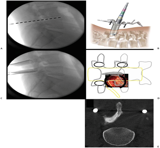 腰椎微创治疗可靠方法之一mistlif手术 - 好大夫在线